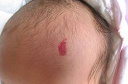 胎記的治療方法有哪些 胎記是怎么產(chǎn)生的