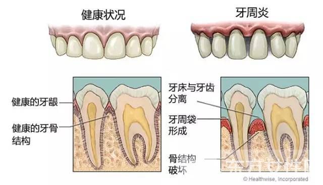 食物塞牙縫怎么辦
