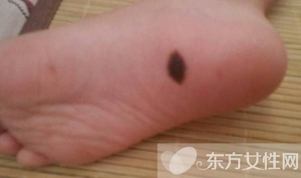 胎記怎么去除 激光去胎記的5大優(yōu)勢