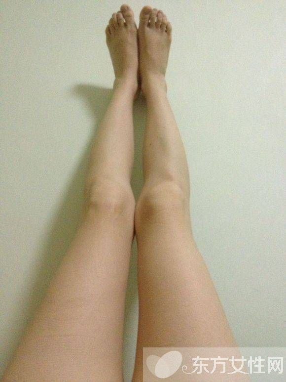 羅圈腿怎么矯正 5個有效方法讓你擁有一雙美腿