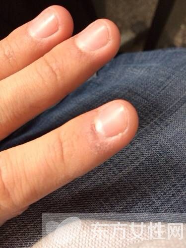 倒刺是什么 指甲倒刺的預(yù)防