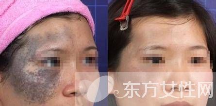 胎記的治療方法有哪些 胎記是怎么產(chǎn)生的