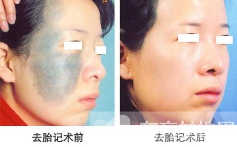 胎記是怎么形成的 怎么去除胎記