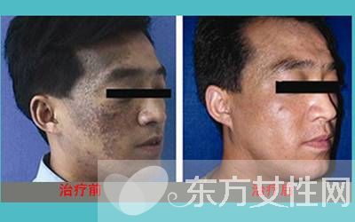 胎記是怎么形成的 怎么去除胎記