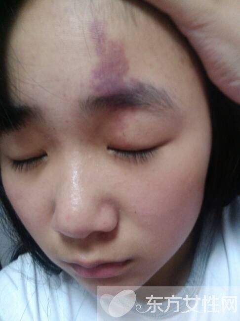 胎記怎么去除 激光去胎記的5大優(yōu)勢