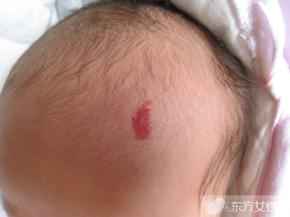 胎記怎么去除 激光去胎記的5大優(yōu)勢