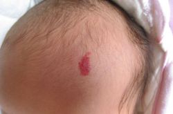 胎記是怎么形成的 胎記對(duì)命運(yùn)也是有影響的哦