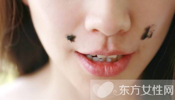 痣是怎么形成的 激光去痣后的6大護(hù)理方法