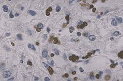 弓形蟲病的癥狀是什么 7大健康飲食教你預(yù)防