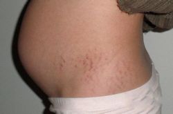 如何預(yù)防妊娠紋 最經(jīng)濟(jì)有效的祛除妊娠紋方法推薦