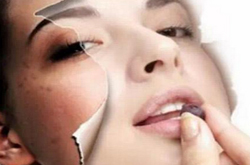 去雀斑有哪些方法 如何才能有效祛除雀斑