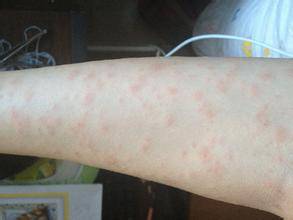 海鮮過敏怎么辦 預(yù)防海鮮過敏的方法