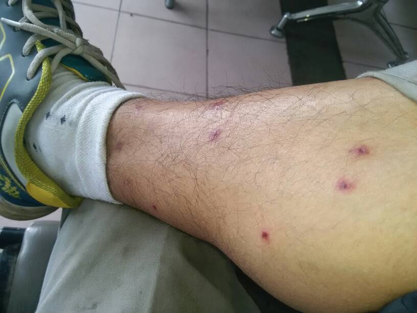 海鮮過敏怎么辦 預(yù)防海鮮過敏的方法