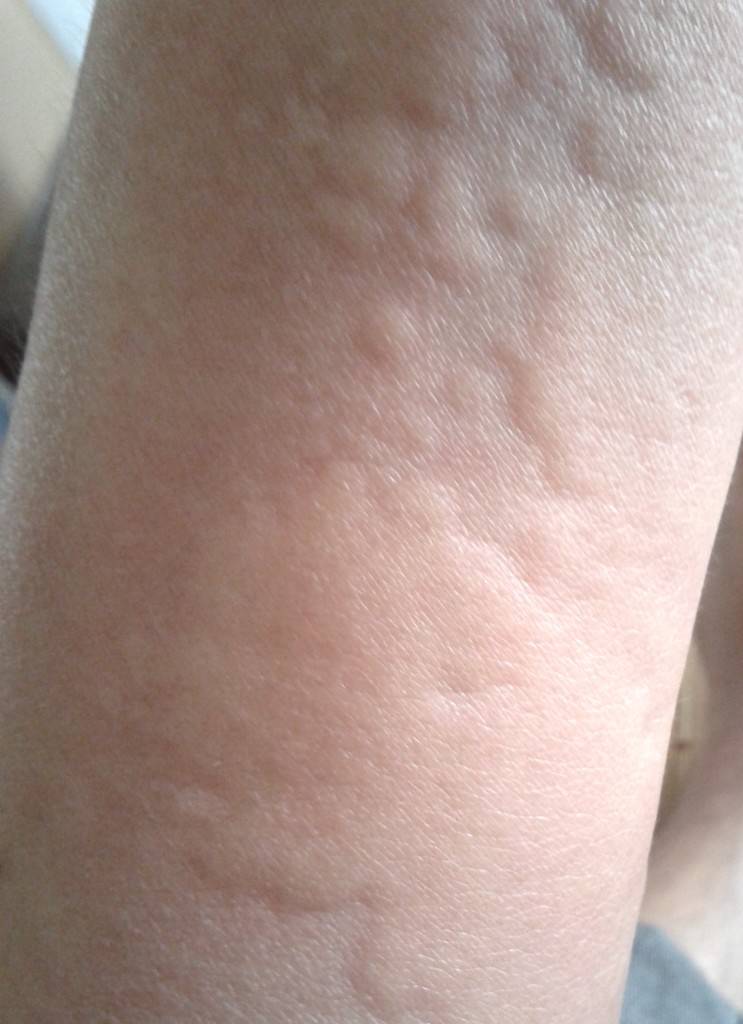 海鮮過敏怎么辦 預防海鮮過敏的方法