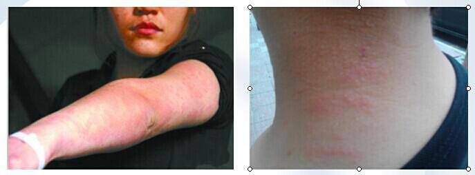 紫外線過敏怎么辦 它有哪些癥狀表現(xiàn)