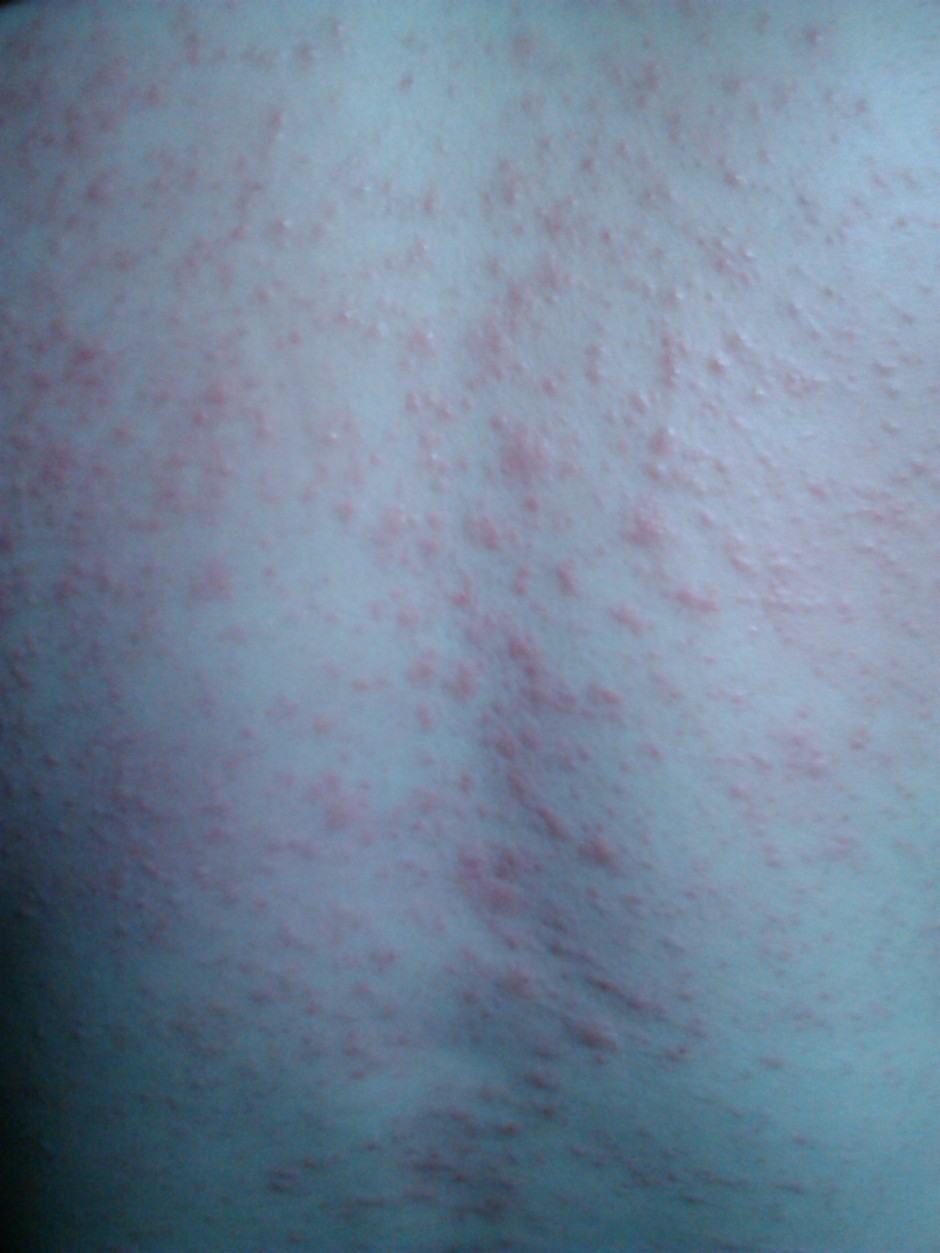 海鮮過敏怎么辦 預(yù)防海鮮過敏的方法