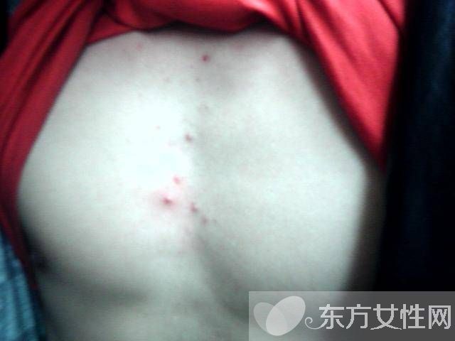 胸前長痘痘的原因有哪些　這些食療方法很見效哦