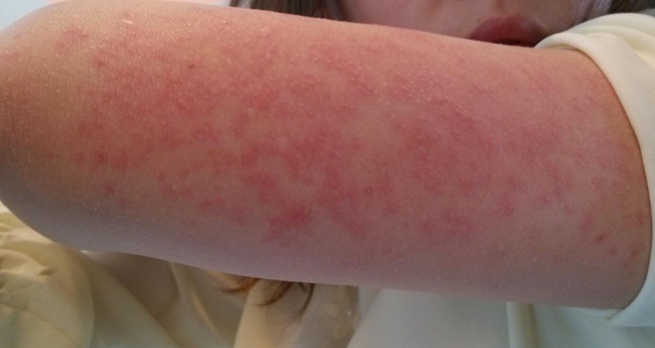 紫外線過敏怎么辦 它有哪些癥狀表現(xiàn)