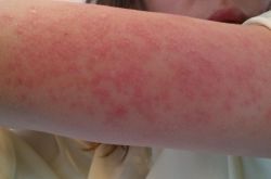 紫外線過敏怎么辦 它有哪些癥狀表現(xiàn)