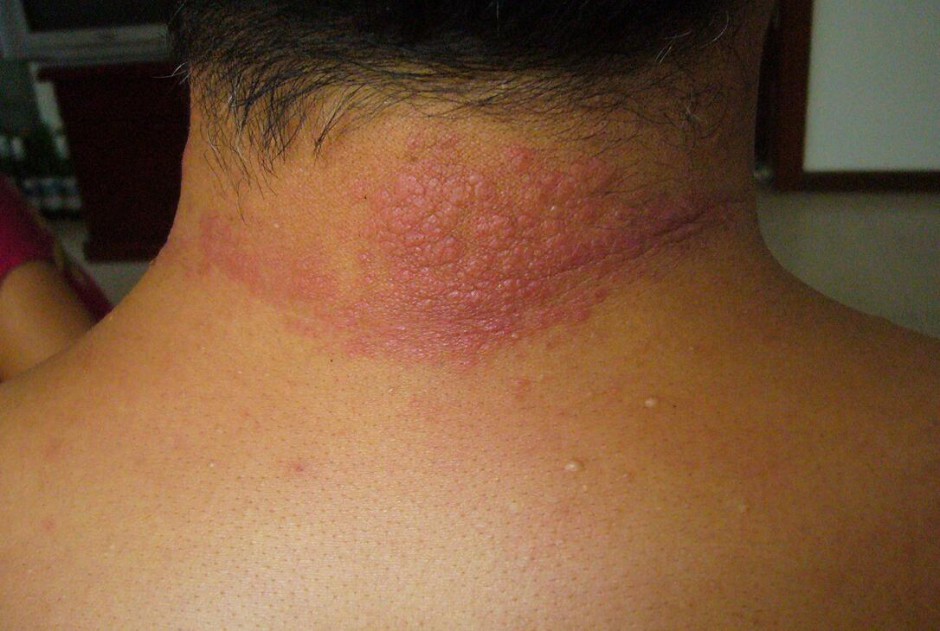 紫外線過敏怎么辦 它有哪些癥狀表現(xiàn)