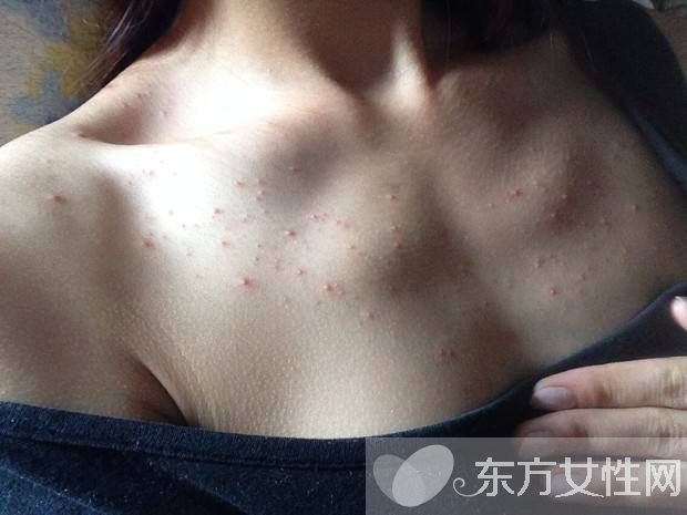 胸前長痘痘的原因有哪些　這些食療方法很見效哦