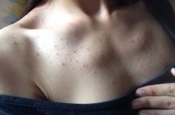 胸前長痘痘的原因有哪些　這些食療方法很見效哦