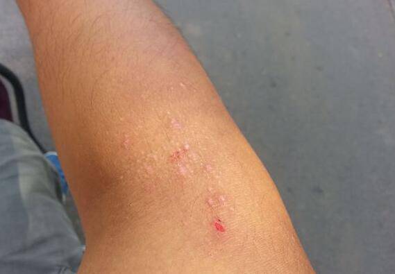 紫外線過敏怎么辦 它有哪些癥狀表現(xiàn)