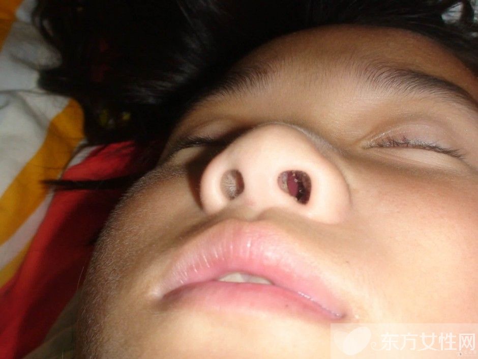 鼻子干疼怎么辦 怎么預(yù)防和護(hù)理你的鼻子