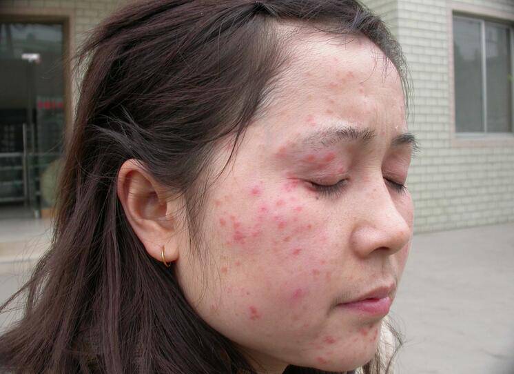 紫外線過敏怎么辦 它有哪些癥狀表現(xiàn)