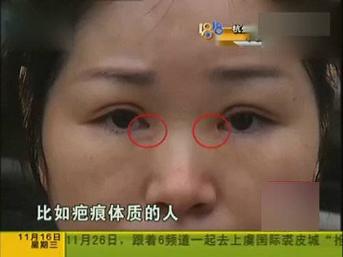 女子整形上班遭拒 割完雙眼皮后眼睛嚇人