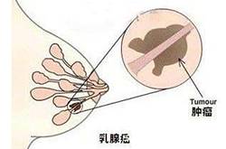 職場女性為什么乳腺癌高發(fā) 我們該如何愛護(hù)乳房