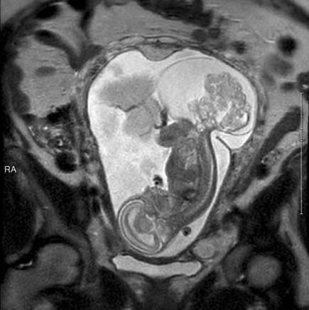 胎兒23周被取出子宮 手術后放回32周健康出生