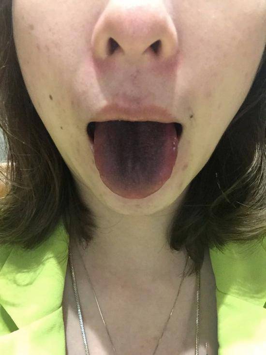 女子吃火鍋舌頭變黑 商家竟這么解釋