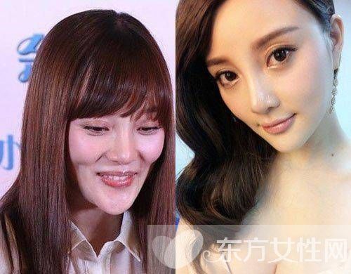 李小璐整容失敗變臉癱 老公賈乃亮力挺愛妻否認(rèn)整容