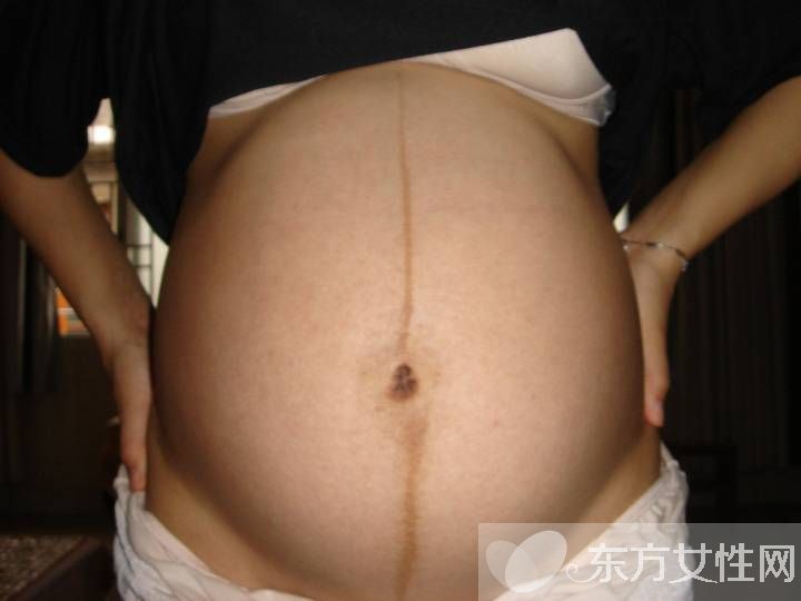 妊娠線可以判斷生男生女 產(chǎn)后如何消除妊娠線