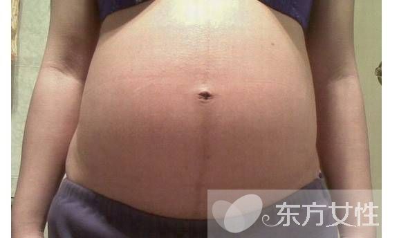 妊娠線可以判斷生男生女 產(chǎn)后如何消除妊娠線