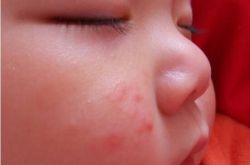 寶寶臉上長廯怎么辦 這些一定要注意