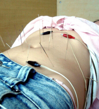 針灸減肥 針灸減肥十大常見問題