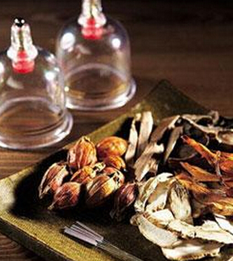 拔罐療法 7類人群不適合拔罐減肥