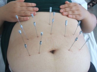 埋線減肥 什么人適合做埋線減肥