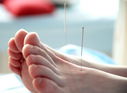 針灸減肥有效嗎 用針灸減肥可瘦的體質(zhì)介紹