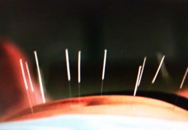 針灸減肥 調(diào)整新陳代謝和內(nèi)分泌功能