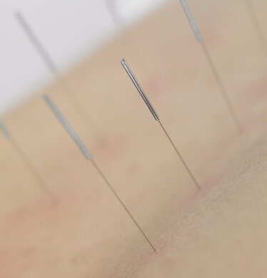 如何針灸減肥 針灸減肥要使用一次性毫針