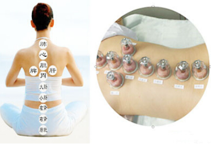 拔罐減肥法 減去體內(nèi)深層多余脂肪