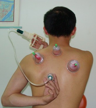 拔罐減肥 關元與氣海穴有增補元氣的作用