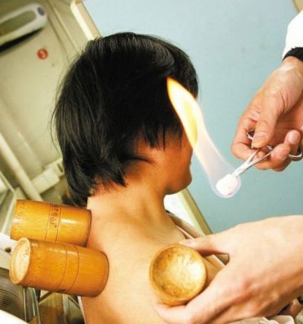 如何拔罐減肥 拔罐減肥施罐法的操作方法