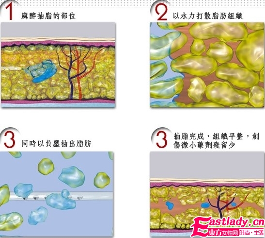 抽脂減肥有沒有生命危險(xiǎn)
