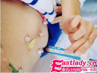 針灸減肥瘦身能成為瘦身絕招嗎