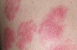 猩紅熱癥狀有哪些呢 患有猩紅熱會有后遺癥嗎