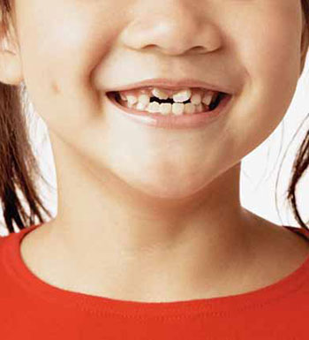 什么是六齡牙  六齡牙對兒童有哪些影響